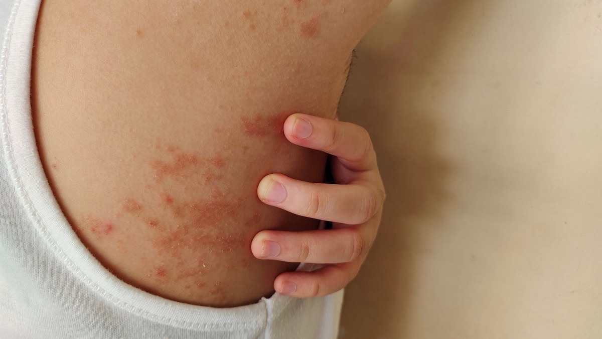 Hanseníase segue em circulação no país e reforça alerta para diagnóstico precoce