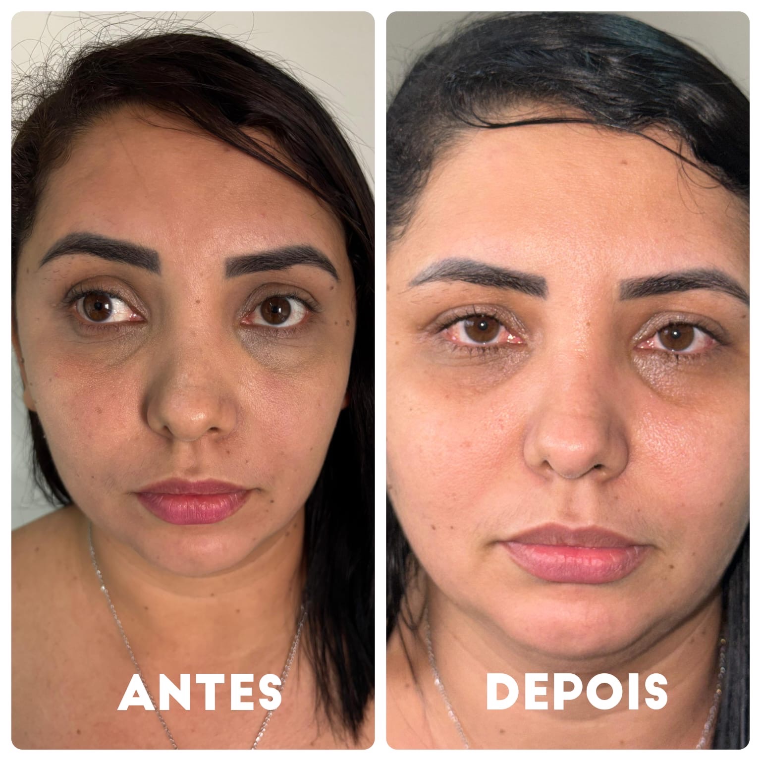 Estrabismo em adultos ainda é pouco tratado, mas cirurgia pode mudar a vida de pacientes